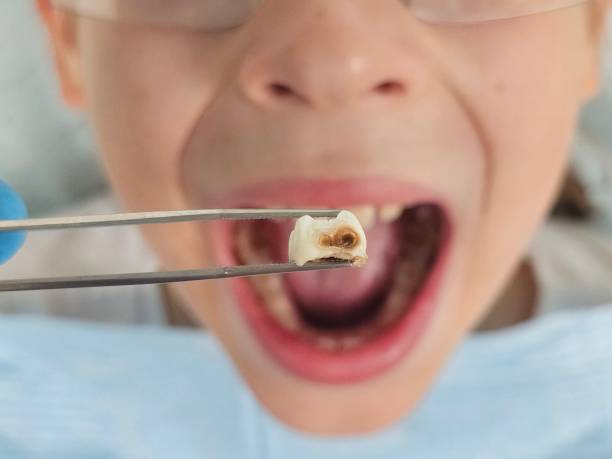 Best Emergency Dental Care for Broken or Chipped Teeth in Edneyville, NC